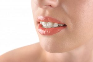 woman smiling with clear braces