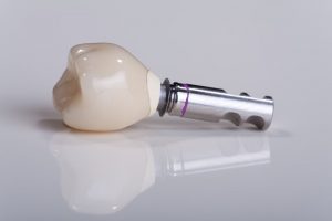 dental implant and crown